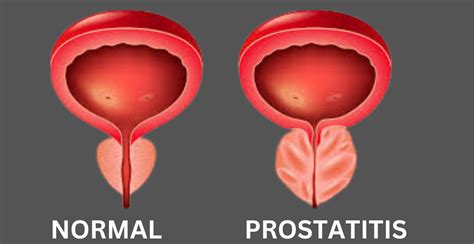 test for prostatitis symptoms